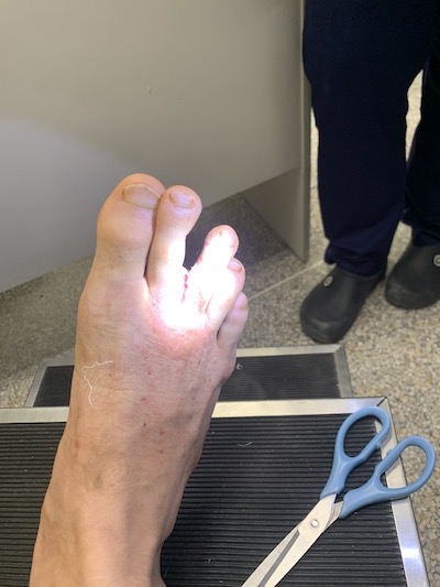 Foot under bright light getting examined with cut between second and third toe
