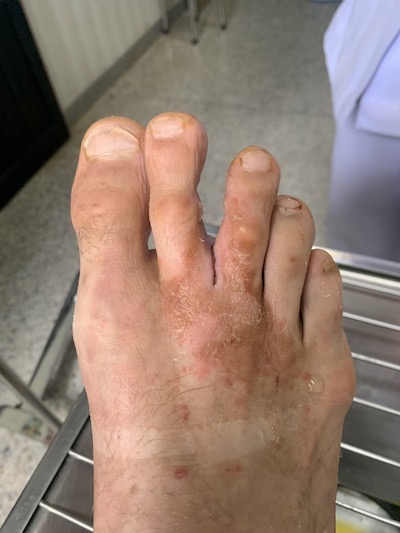 Cloused wound on foot