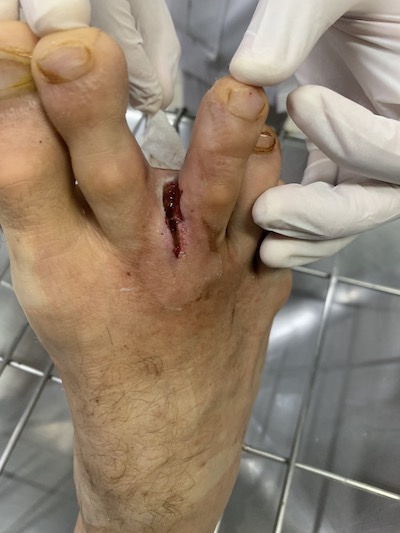 My Foot on August 8, 2021: A deep cut on the right foot between the second and third toe.